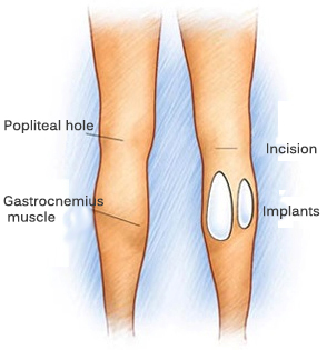 Calves-increased-prosthetics